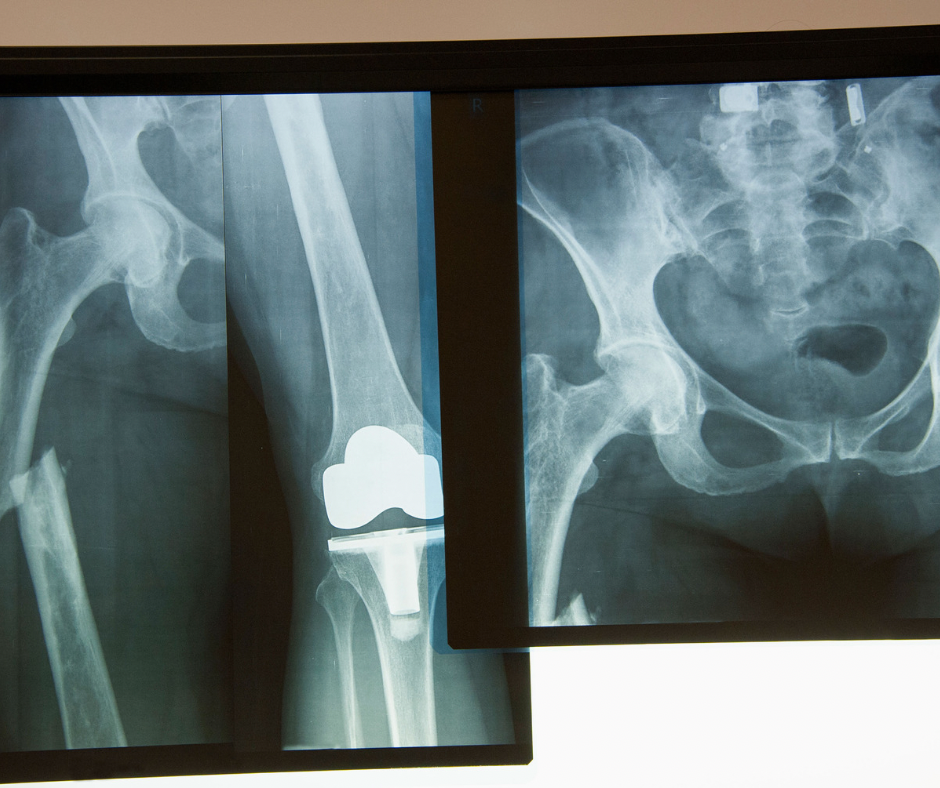 5 Semne Că Ai Nevoie de un Ortoped în Cluj (Și Cum Te Ajută KinetikMed)